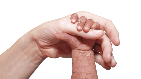 Caring For Ichthyosis